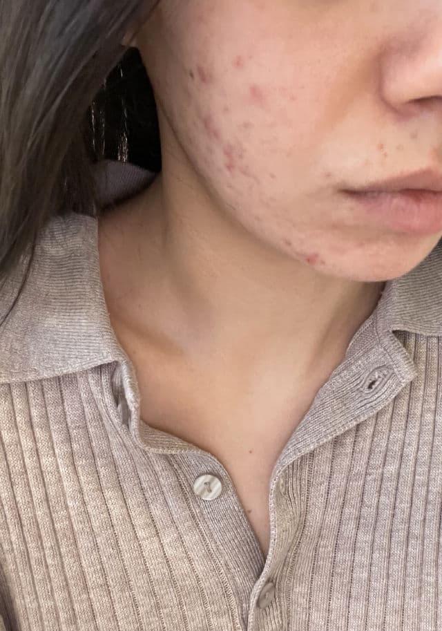 Kate Somerville EradiKate Acne Treatment review photo by sevd