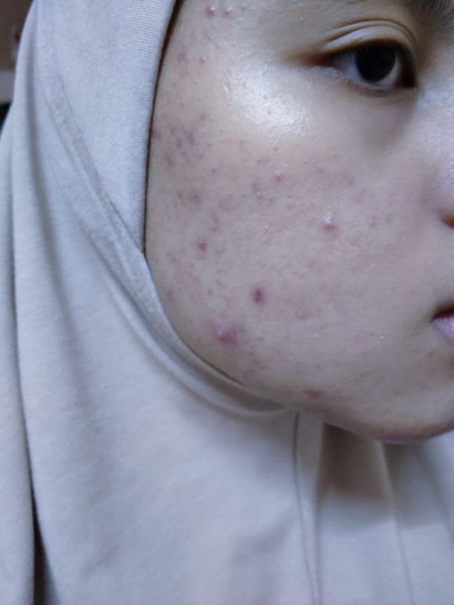 ALWAYS BE PURE Forest Therapy Repair Concentrated Ampoule review photo by sweetie