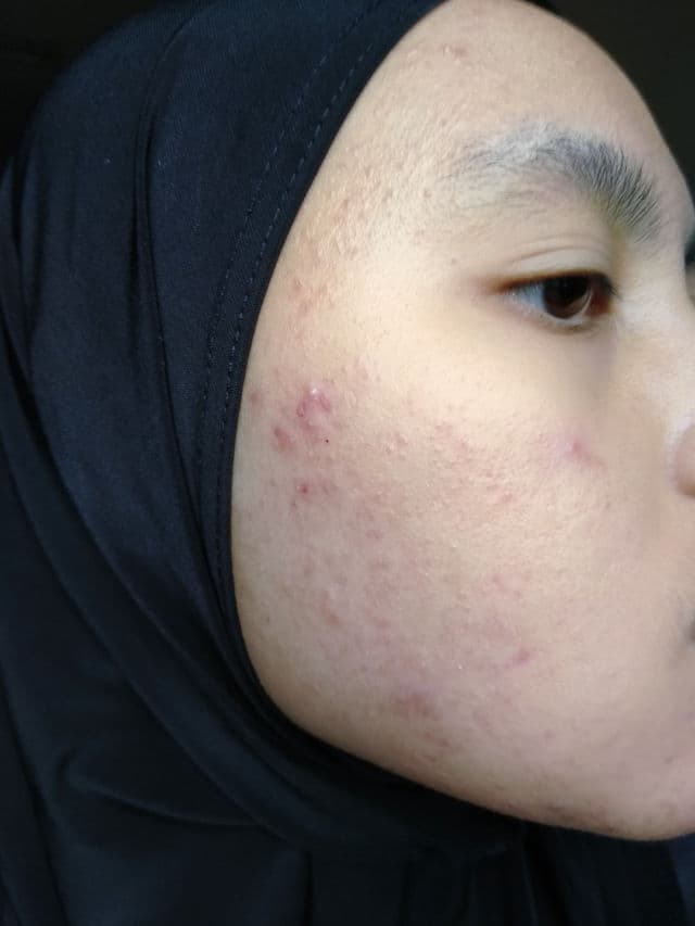 ALWAYS BE PURE Forest Therapy Repair Concentrated Ampoule review photo by sweetie