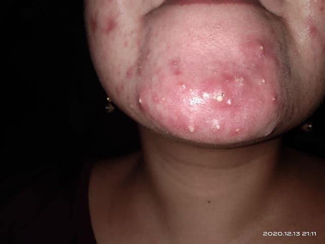 Oxecure Acne Clear Powder Mud review photo by theasprouse