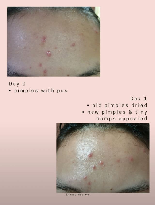 Sferangs Clearing T-Care AMED A Spot Solution review photo by thesundaefave