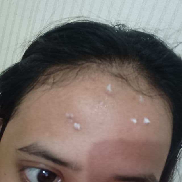 COMMONLABS Vitamin E Micro Needle Spot Cream review photo by tribuanartd