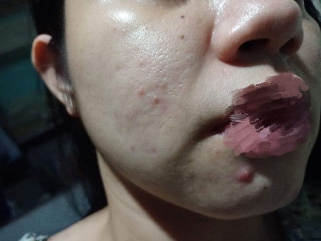 Dermorepubliq 10% Niacinamide + Hyaluronic Acid Face Anti-Blemish Serum review photo by tyaraa