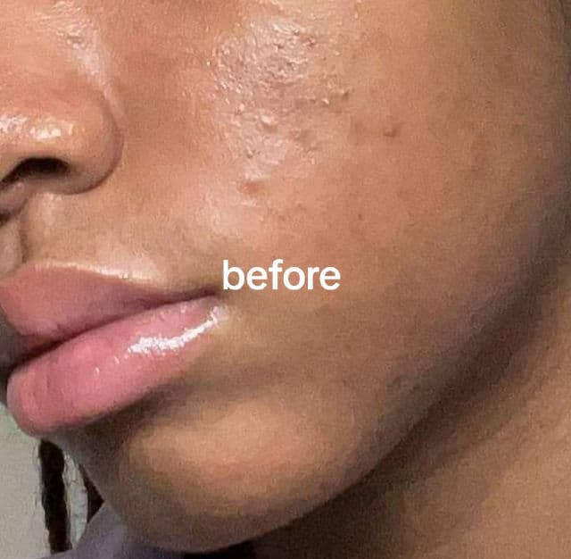 SNP Glutathione Dark Zero Toning Patch review photo by stillellaann