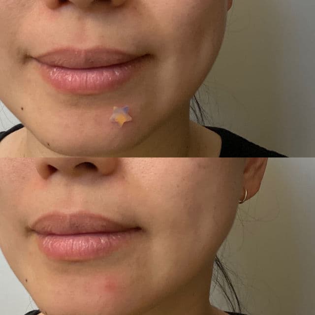 LitBear Acne Patch Pimple Patch for Face review photo by NguyenAndOngLy