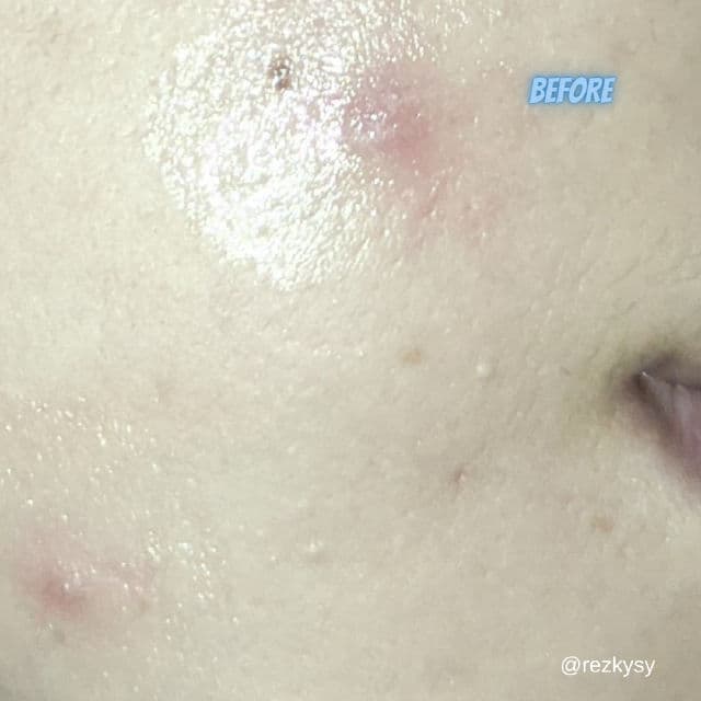 ERHA Acne Care Lab Acne Spot Gel review photo by Rezky