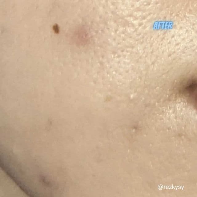 ERHA Acne Care Lab Acne Spot Gel review photo by Rezky