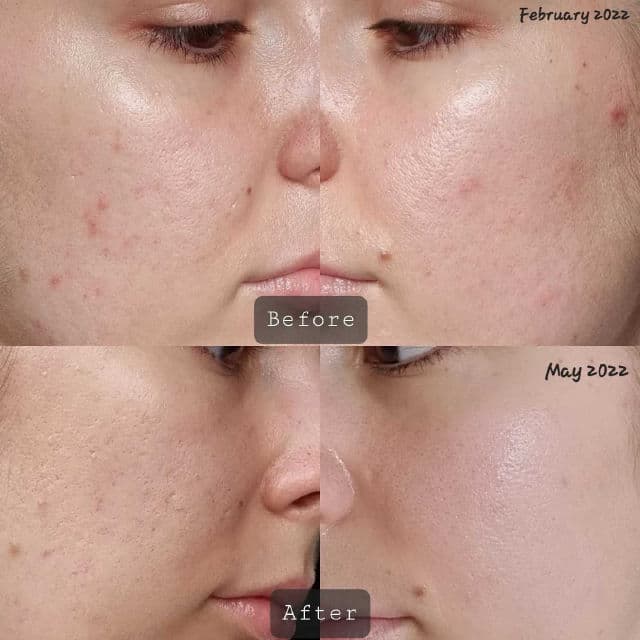 Dermatica Tretinoin + 4% Niacinamide review photo by SkincarebyAlex