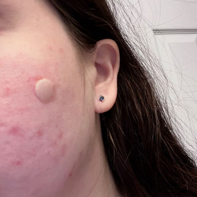 PanOxyl PM Overnight Spot Patches review photo by samwalters