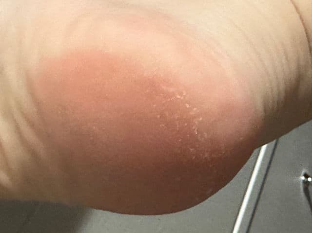 Baby Foot Exfoliation Foot Peel review photo by mormor