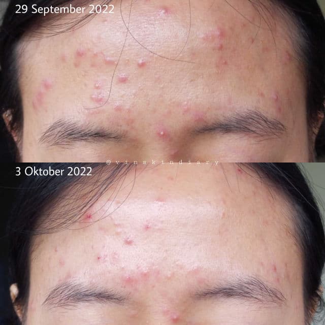 Lacoco en nature Grape Fruit Acne Fighter Serum review photo by vinskindiary