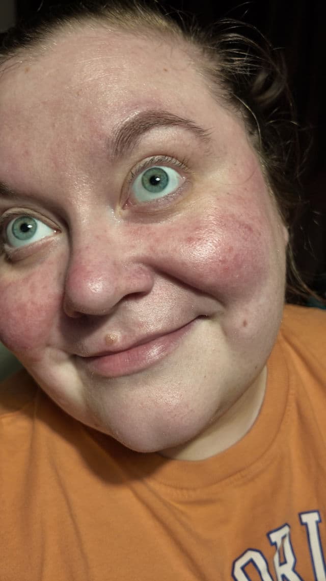 Azelaic Acid 10 Hyaluron Redness Soothing Serum product review