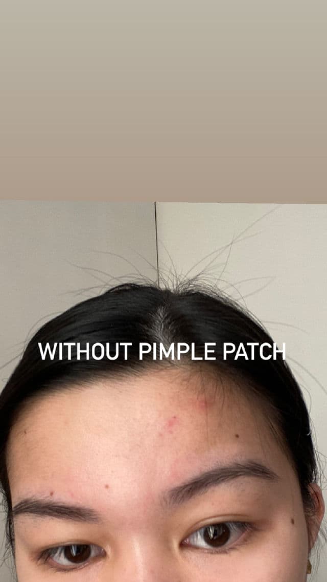 MEDIHEAL A-Zero Shot Skin Dressing Patch review photo by Elai