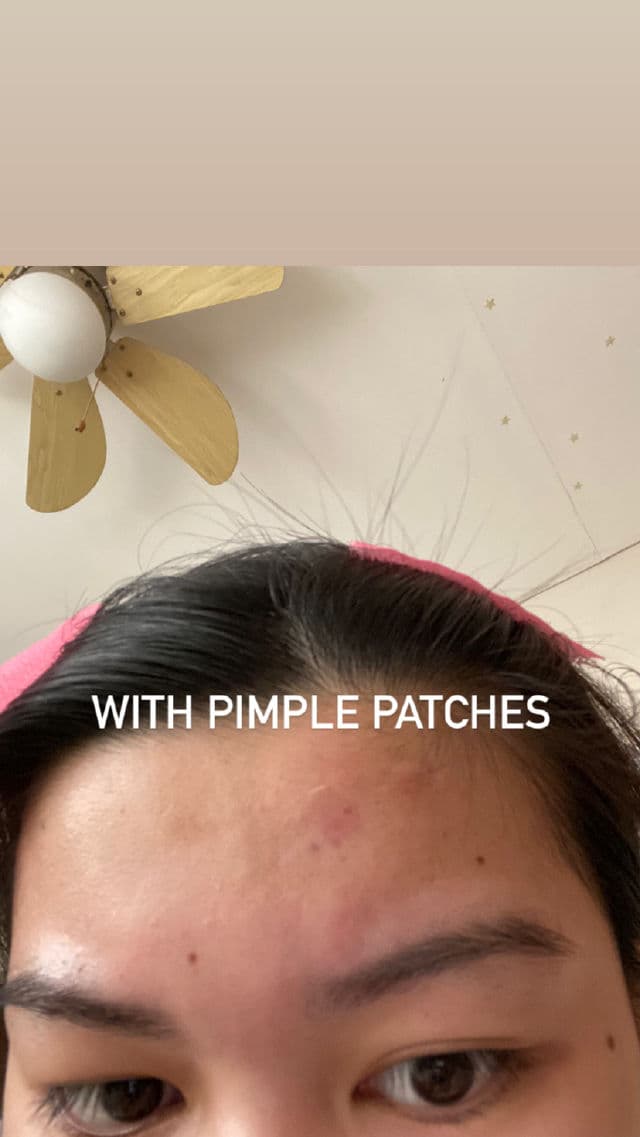 MEDIHEAL A-Zero Shot Skin Dressing Patch review photo by Elai