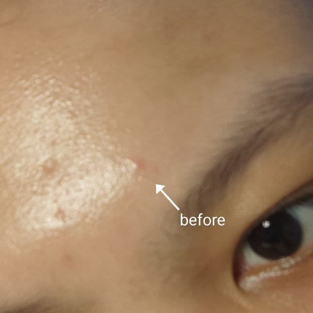 MEDIHEAL A-Zero Shot Skin Dressing Patch review photo by SkincareSushi