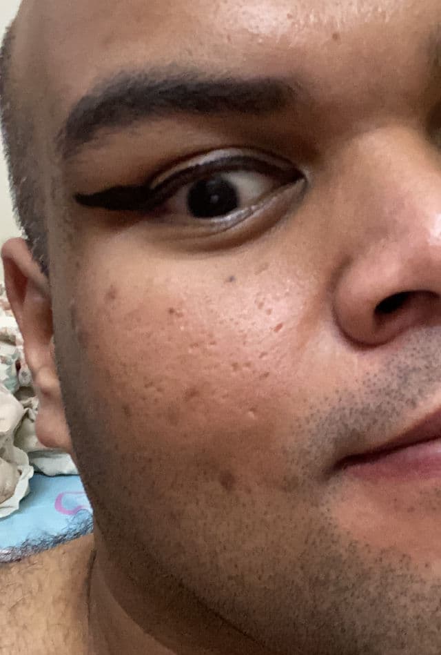 Skinlex 2% Alpha-Arbutin Serum review photo by jattali17