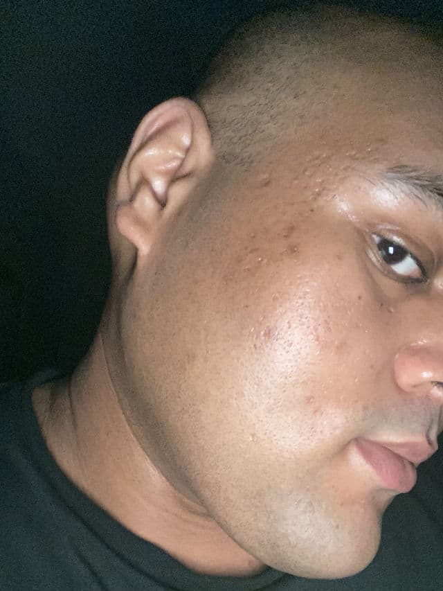 Skinlex 2% Alpha-Arbutin Serum review photo by jattali17