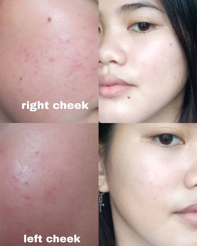 SkinABCs Niacinamide for Oily and Acne-Prone Skin Serum review photo by jiyoisuu