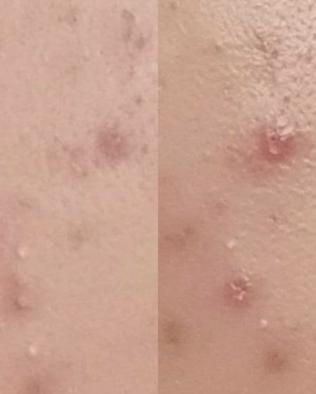 QUICK FX Pimple Eraser review photo by lingskinlove