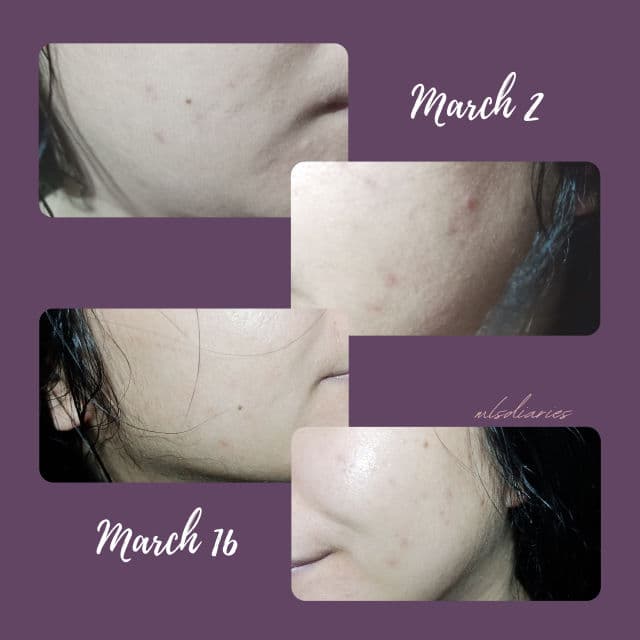 COSRX AC Collection Ultimate Spot Cream review photo by mlsdiaries